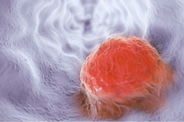 AI Breakthrough Doubles Early Esophageal Cancer Detection 🌟🔍 AI_Breakthrough_Doubles_Early_Esophageal_Cancer_Detection___