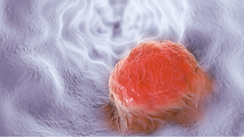 AI_Breakthrough_Doubles_Early_Esophageal_Cancer_Detection___