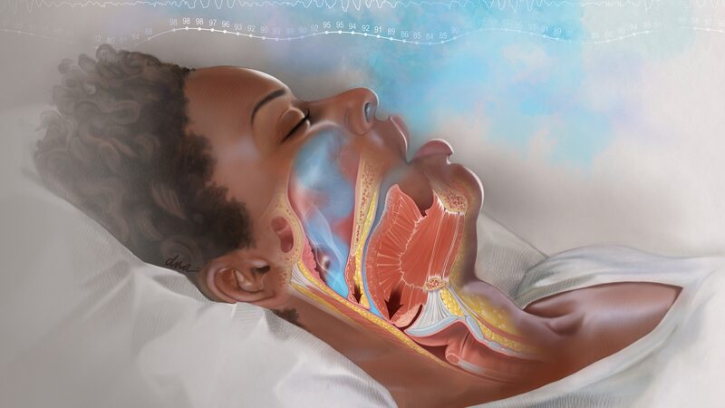 Snoring_Linked_to_Higher_Blood_Pressure__Study_Reveals___