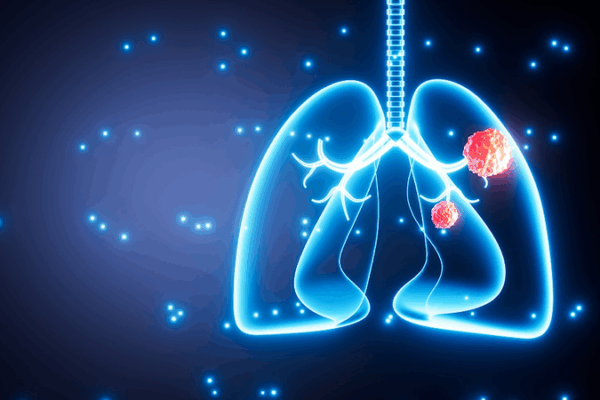 🌬️ Air Pollution Tied to Lung Cancer Mutations in Non-Smokers, Study Finds 🌬️ Air Pollution Tied to Lung Cancer Mutations in Non-Smokers, Study Finds