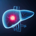 75GRNUNSF6C82CXG9SUS - 🌍NewspaperAmigo – Your Global News Buddy 🗞️ China-Led Lancet Report Maps Global Liver Cancer Fight 🌍🩺