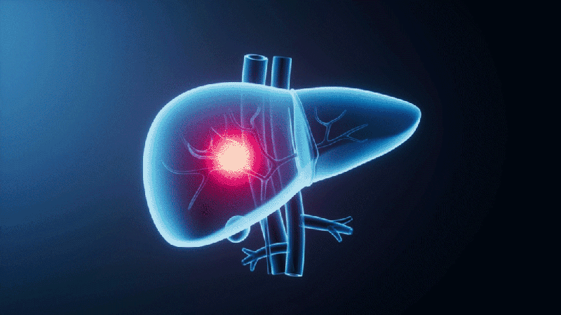 China-Led Lancet Report Maps Global Liver Cancer Fight 🌍🩺