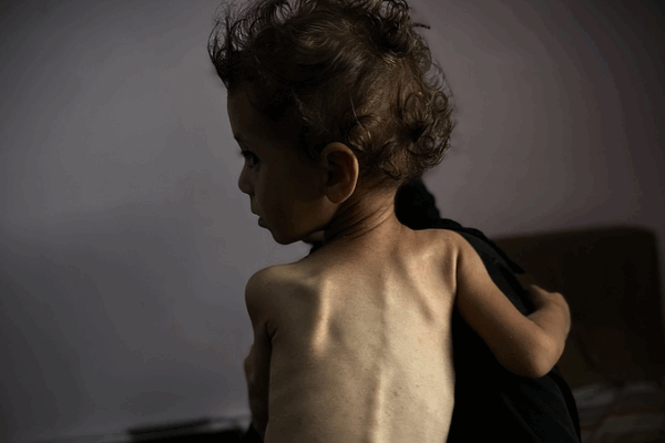 Gaza Famine Crisis: A Human-Made Catastrophe ππ Gaza Famine Crisis: A Human-Made Catastrophe ππ