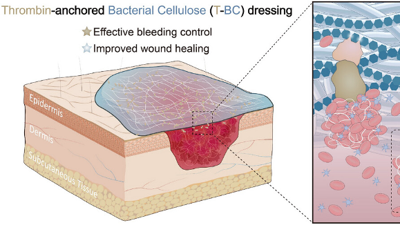 Chinese Scientists Revolutionize Burn Care with Bioactive Dressing 🌟🩹 Chinese Scientists Revolutionize Burn Care with Bioactive Dressing 🌟🩹