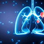 🚭 1 in 5 Lung Cancer Patients Never Smoked: Global Study