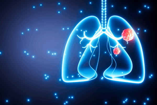 🚭 1 in 5 Lung Cancer Patients Never Smoked: Global Study 🚭 1 in 5 Lung Cancer Patients Never Smoked: Global Study