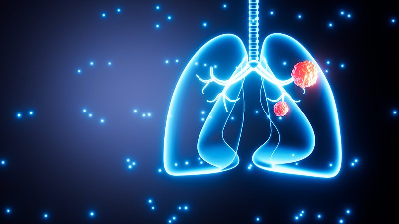 0PTZCLF1SH69OE4P29PF - 🌍NewspaperAmigo – Your Global News Buddy 🗞️ 🚭 1 in 5 Lung Cancer Patients Never Smoked: Global Study