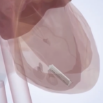 VFI79XMZTPCRUPP50GV9 - 🌍NewspaperAmigo – Your Global News Buddy 🗞️ China Unveils Self-Powered Micro Pacemaker in Medical Breakthrough 🌟💊