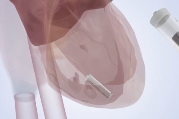 China Unveils Self-Powered Micro Pacemaker in Medical Breakthrough 🌟💊