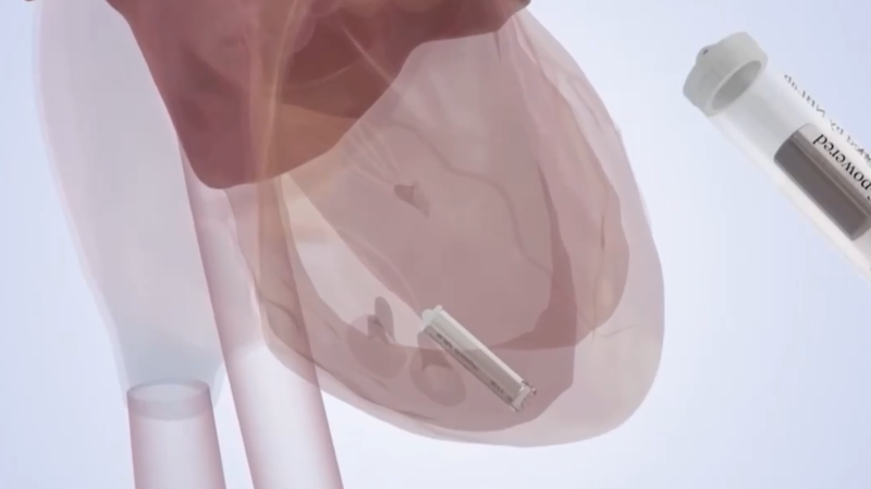 China Unveils Self-Powered Micro Pacemaker in Medical Breakthrough 🌟💊