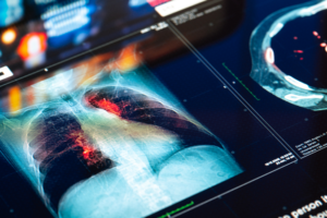 Artificial Lung Breakthrough Saves Patient in 48-Hour Race Against Time 🏥💨