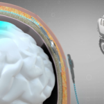 China Pioneers World’s First Invasive BCI for Medical Use 🧠💡