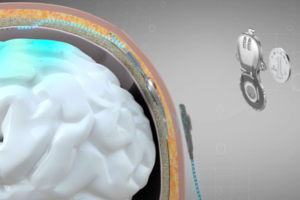 China Pioneers World’s First Invasive BCI for Medical Use 🧠💡